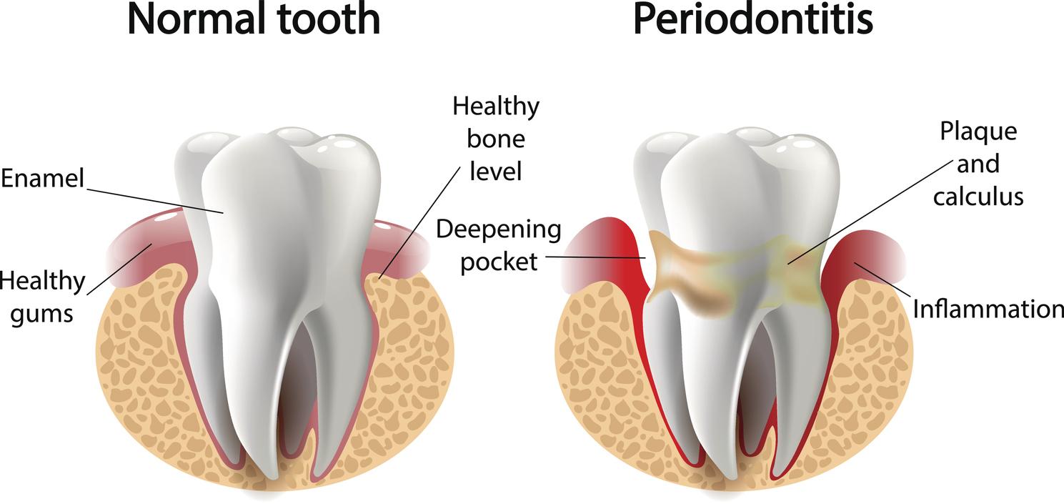 Gum Disease And Its Link To Your Heart And Brain